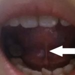 「黐脷根」正式名稱是舌繫帶過短或舌繫帶縮短症