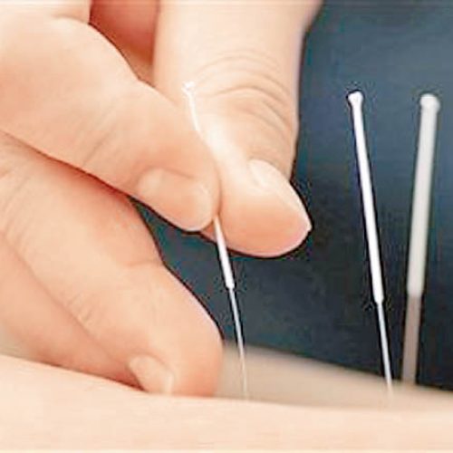 針灸或增人工受孕成功率