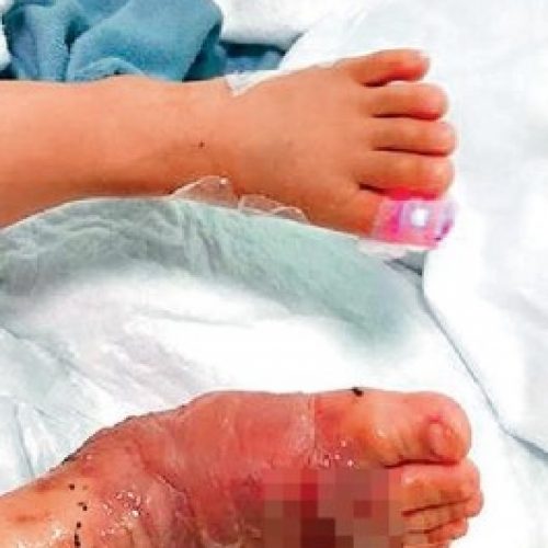 輸液外滲　瑪麗致歉 兩歲女「打豆」變腳爛
